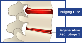 Bulging Disc